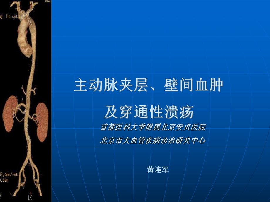 主動脈夾層、壁間血腫及穿通性潰瘍的影像診斷與鑒別診斷ppt課件.ppt_第1頁