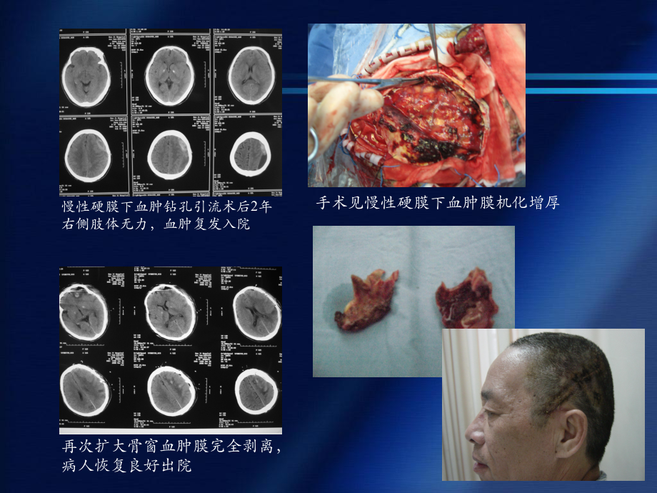 中國顱腦創(chuàng)傷救治指南解讀.ppt_第1頁