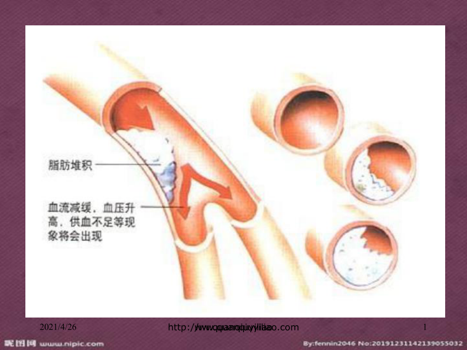 關(guān)注高血脂高血脂 ppt課件醫(yī)學(xué)課件_第1頁