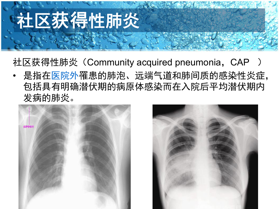 臨床病例分析:肺炎-社區獲得性肺炎_第3頁