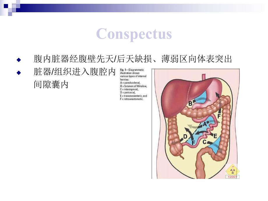 腹外疝上网版资料讲解