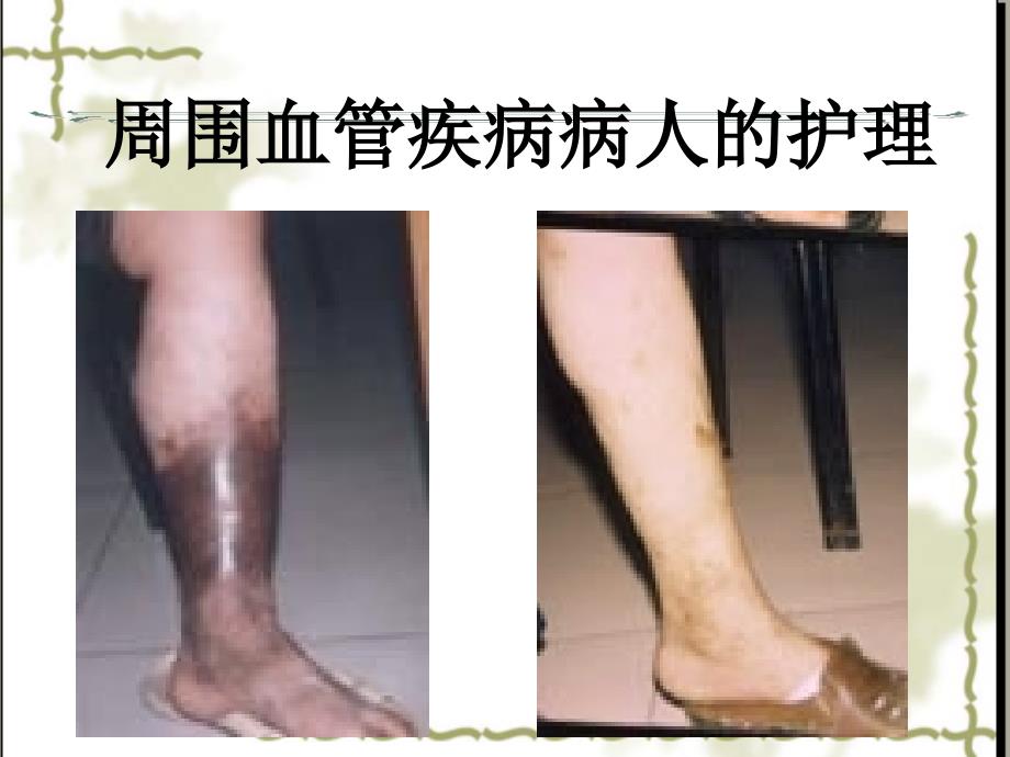 周围血管与淋巴管疾病ppt课件_第1页