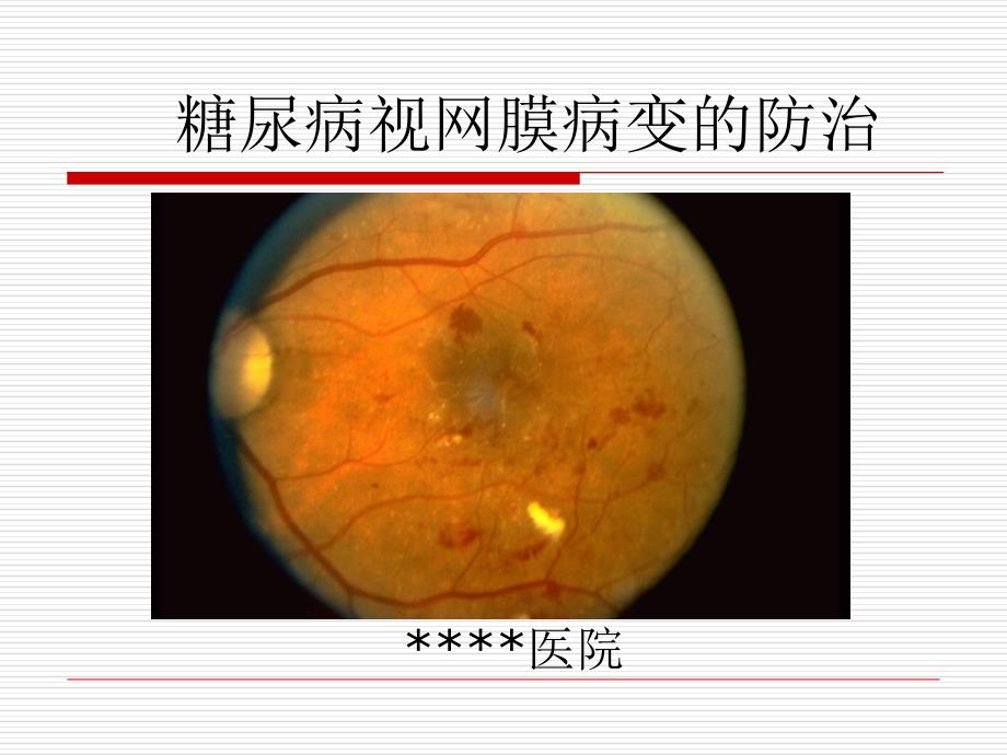 糖尿病视网膜病变宣教[1]_第1页