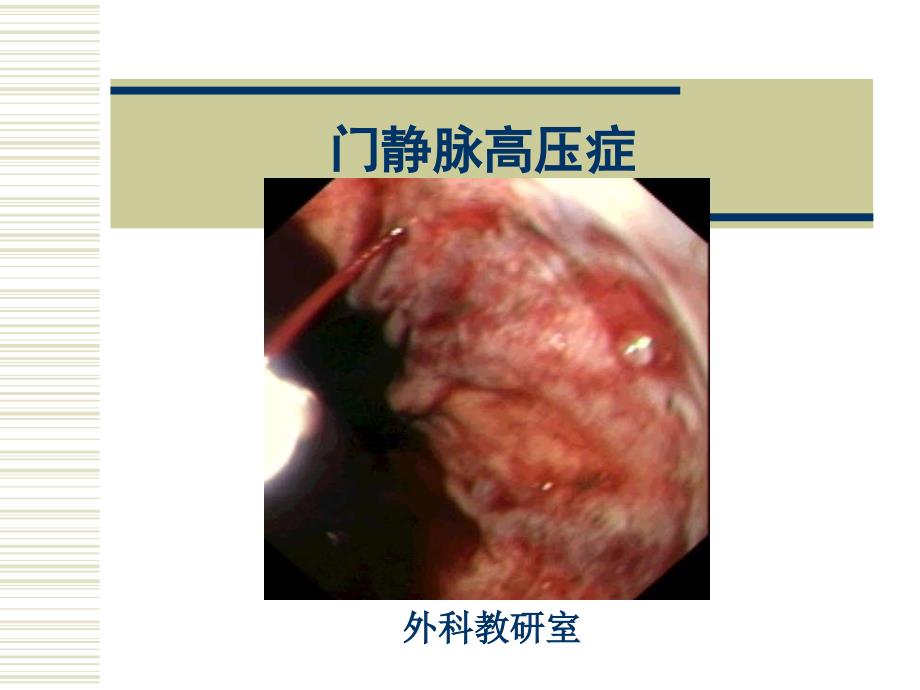 上消化道出血外科治疗_第1页