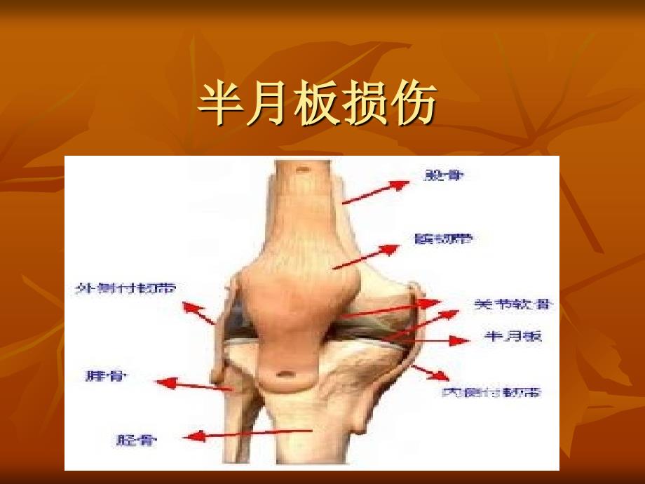 半月板损伤影像表现_第1页