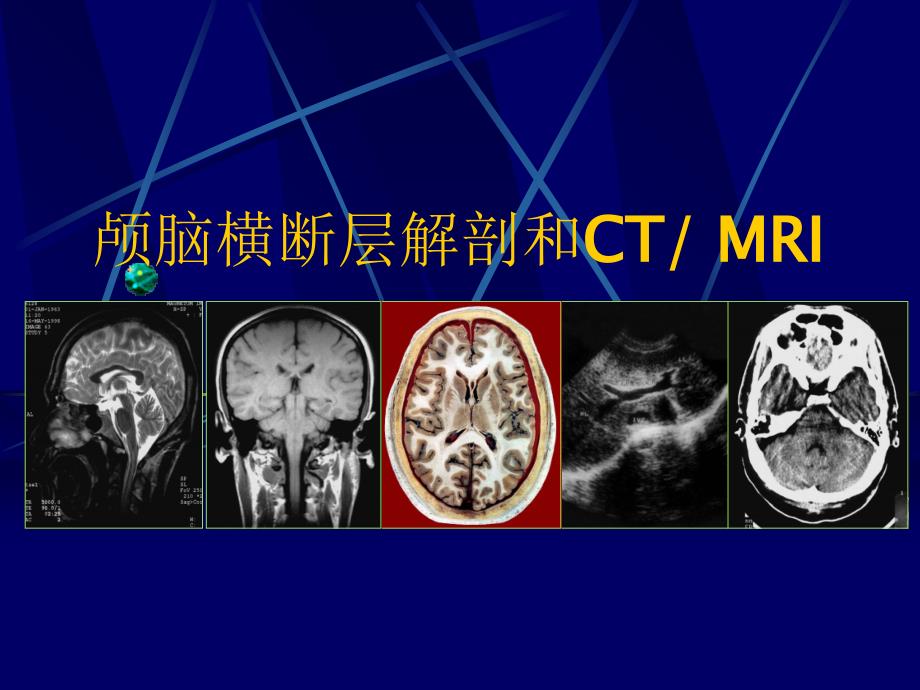 颅脑横断层解剖和CT、MRI_第1页