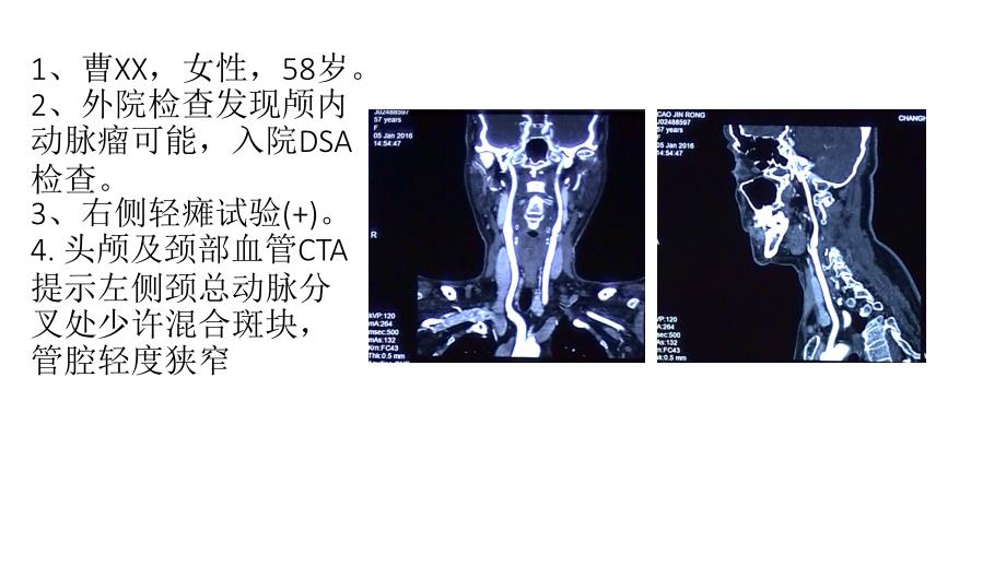 颈动脉狭窄治疗选择CAS还是CEA课件_第1页