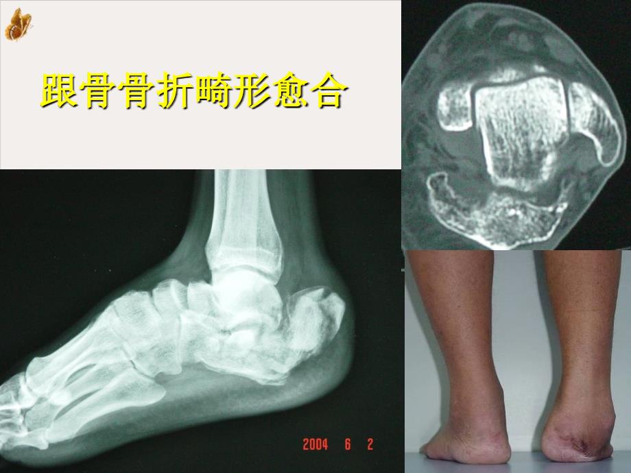 跟骨畸形愈合治疗课件_第1页