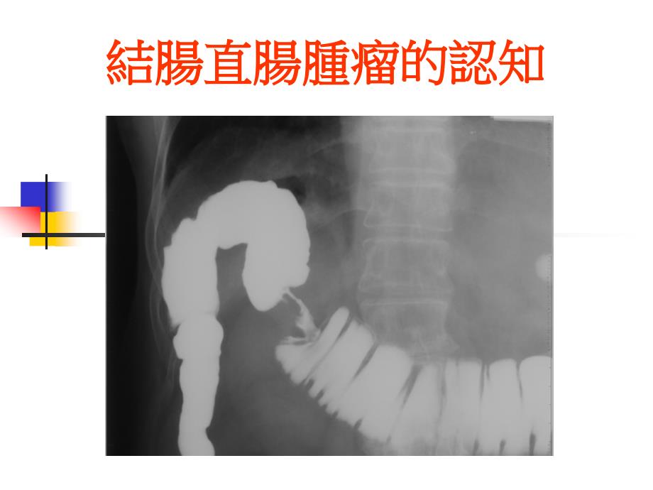 直肠癌的临床症状及表徵课件_第1页