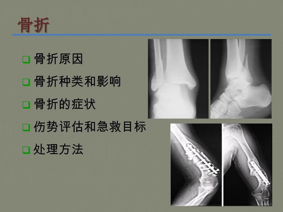 骨折的急救处理与搬运课件_第1页