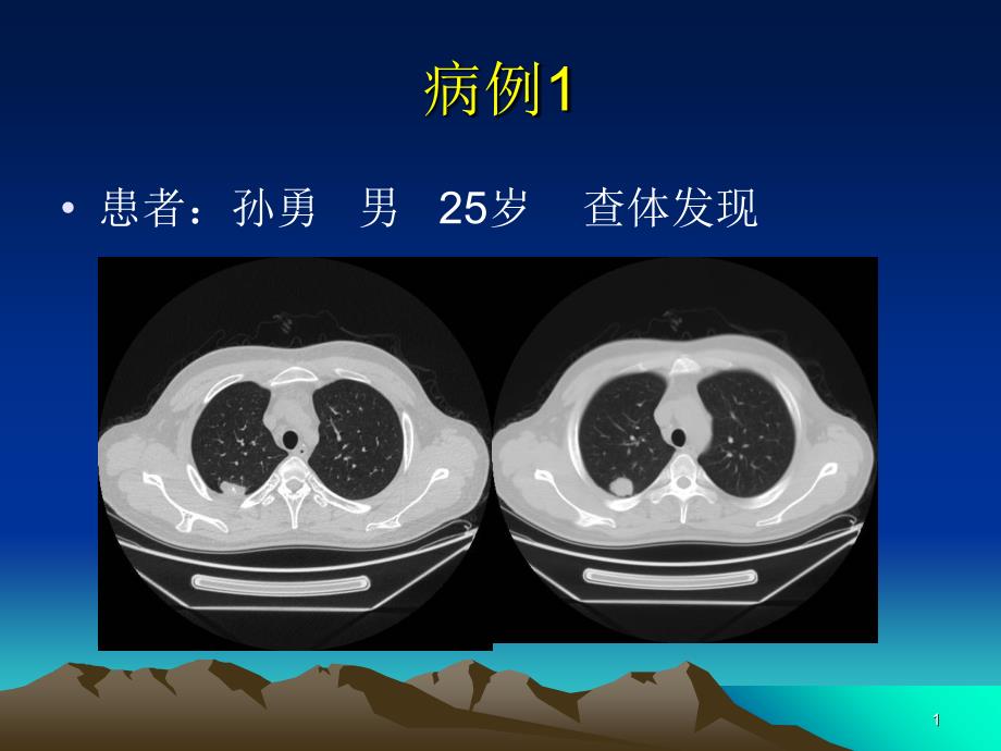 肺错构瘤影像表现_第1页