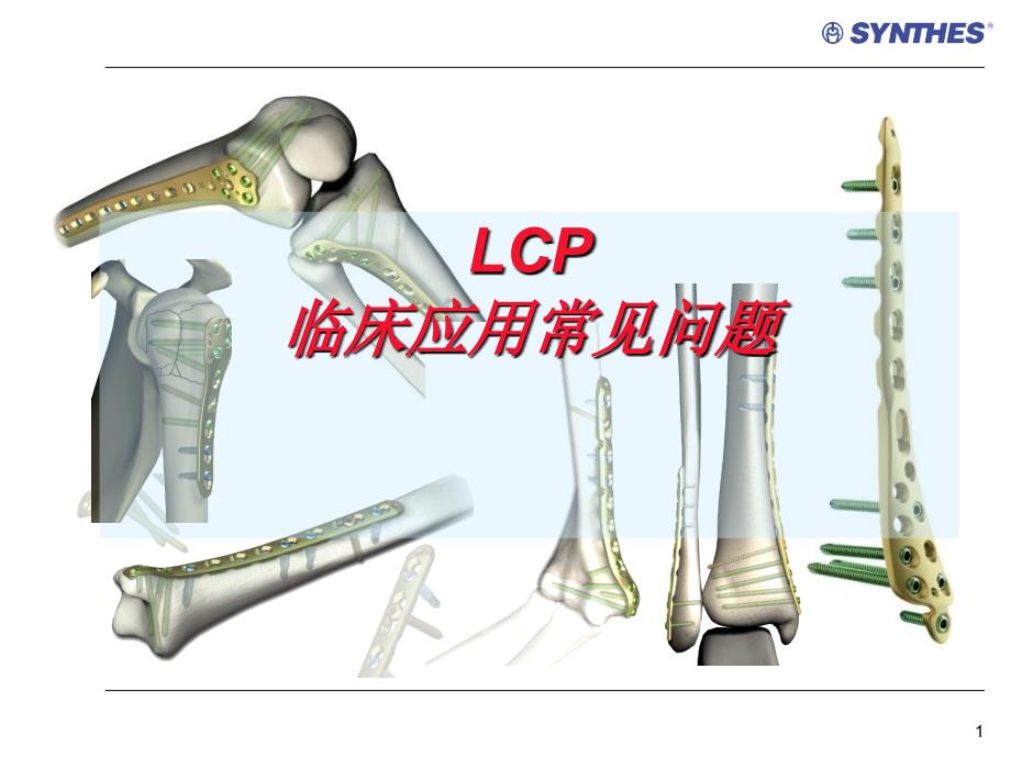 锁定内固定系统临床应用常见问题LCP-Qu_第1页