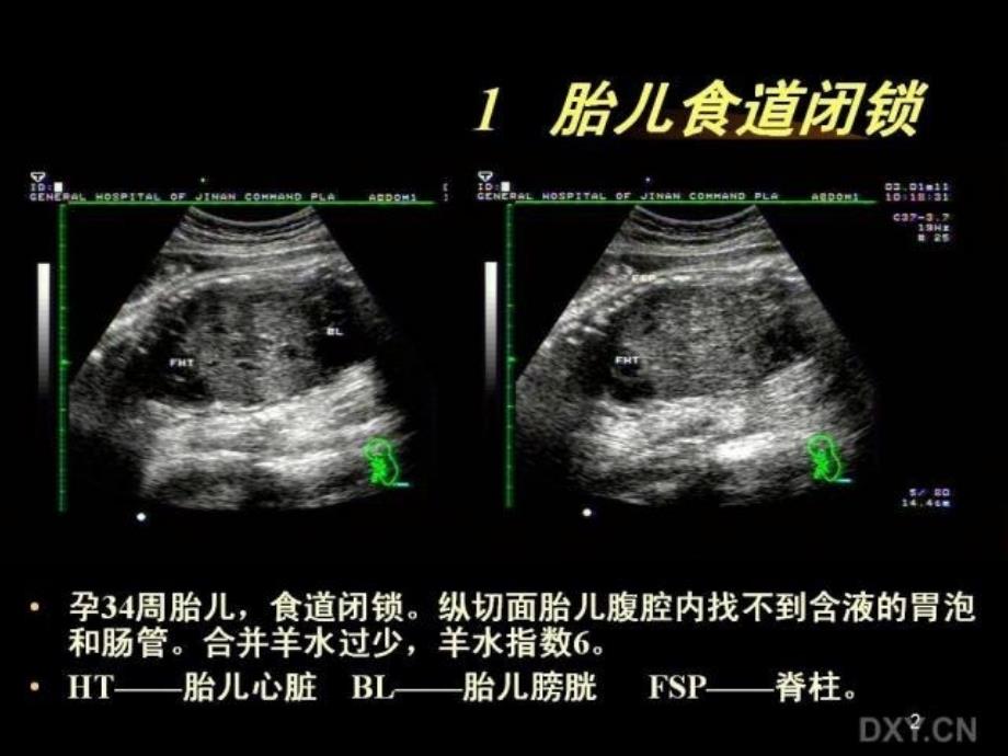 胎儿腹部畸形的超声诊断课件整理整理_第1页