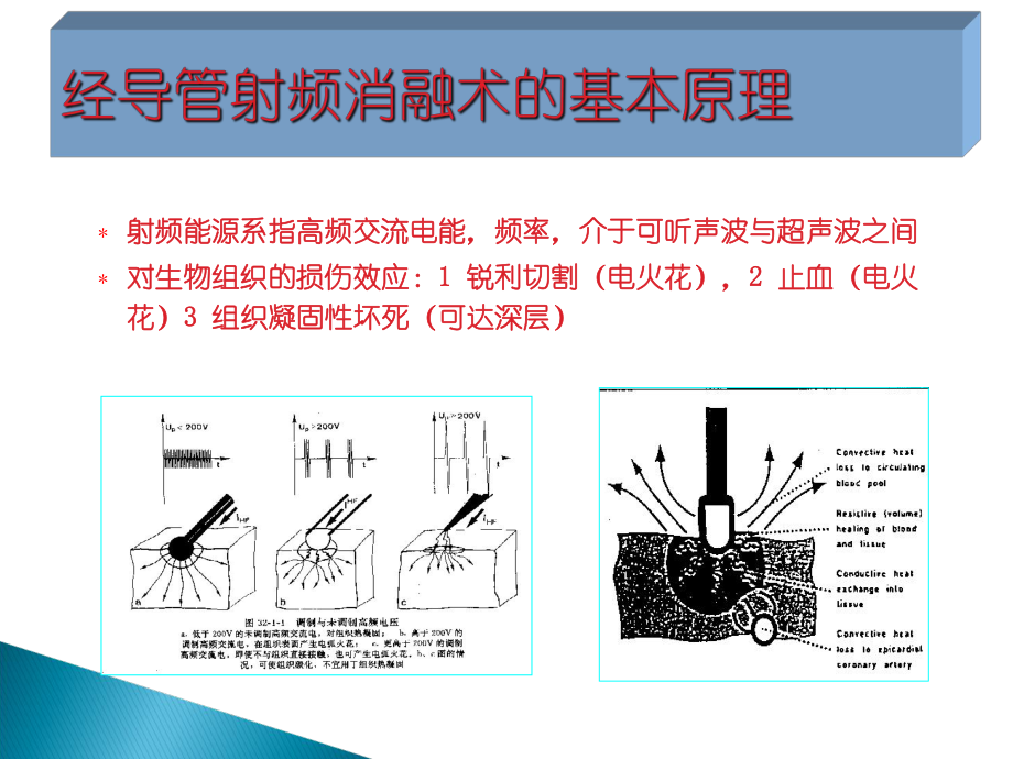 经导管射频消融术的基本原理ppt1250