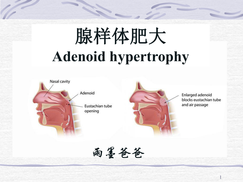 腺样体肥大课堂PPT_第1页