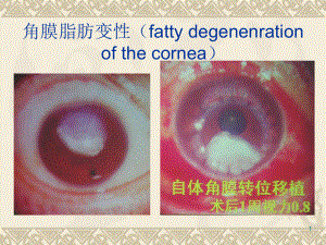 角膜脂肪变性