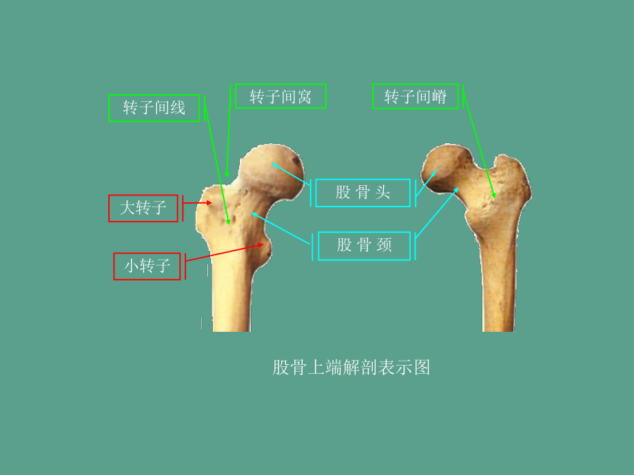 股骨转子间骨折ppt课件