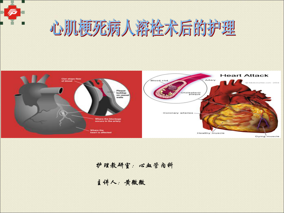 心肌梗死溶栓術(shù)后的護理課件_第1頁