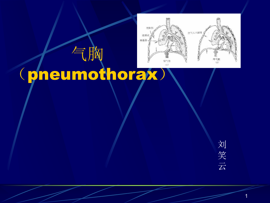 氣胸ppt課件_第1頁