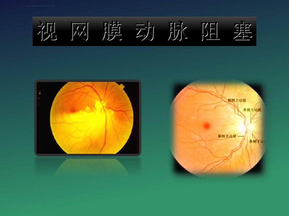 视网膜动脉阻塞ppt课件_第1页