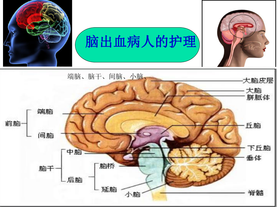 脑出血的护理PPT课件_第1页