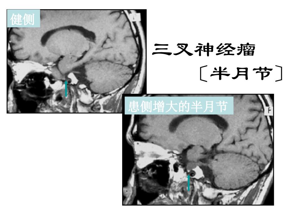 各条颅神经清晰MRI影像3_第1页