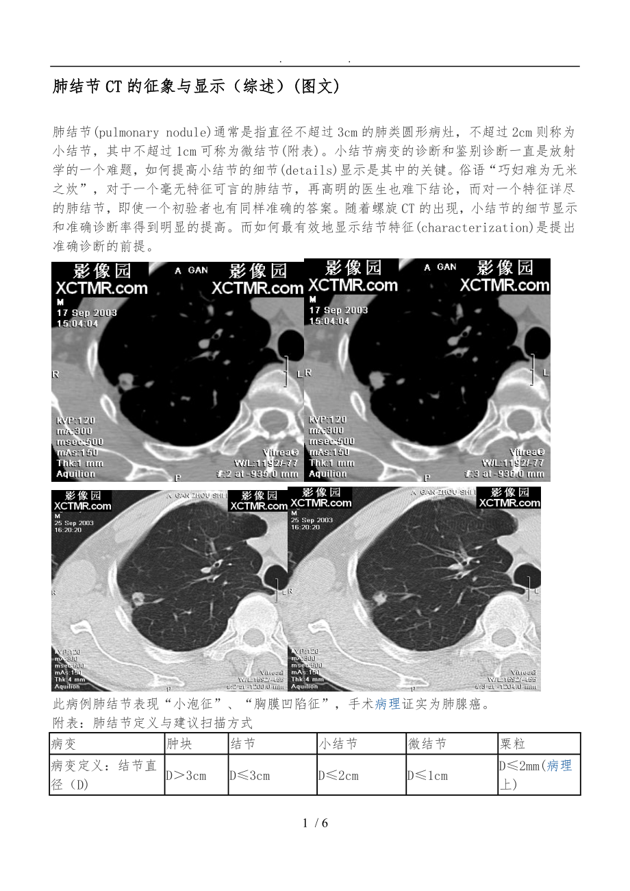 肺结节CT的征象及显示_第1页