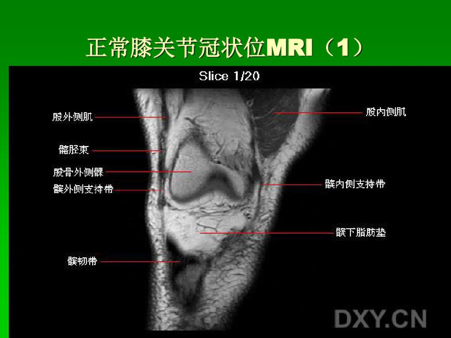 膝关节MRI冠状位1_第1页