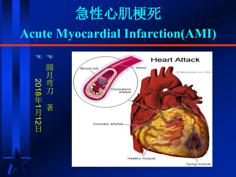 急性心肌梗死.ppt_第1頁