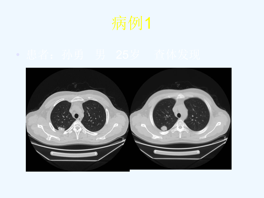 肺错构瘤影像表现ppt课件_第1页