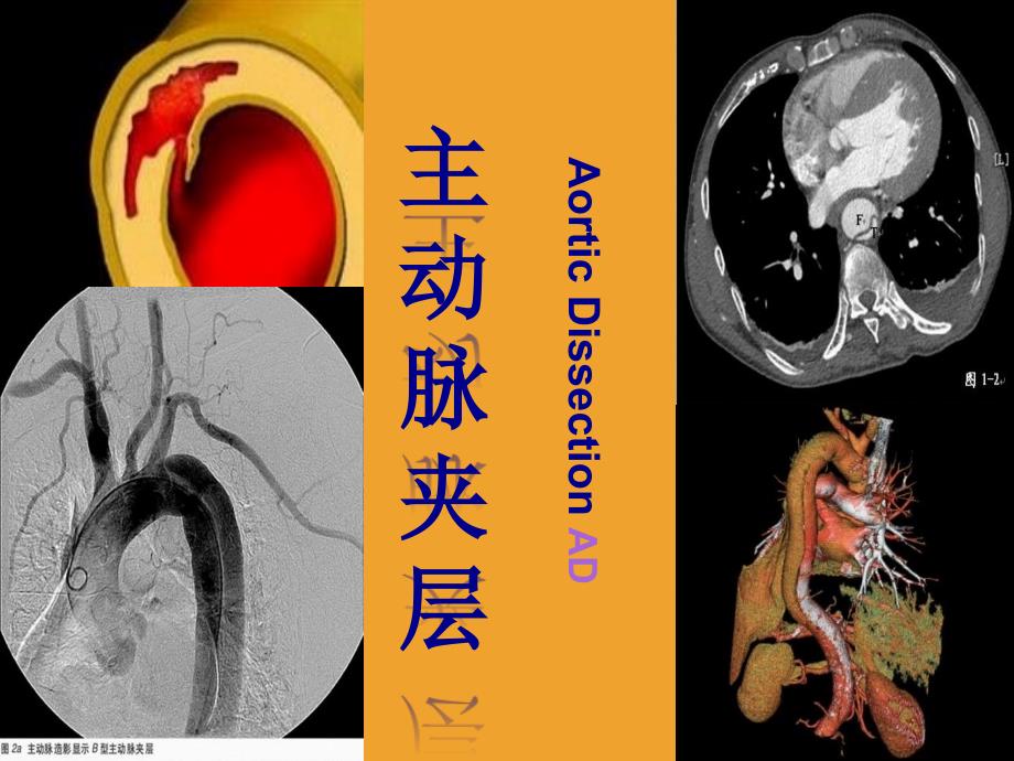 主动脉夹层-ppt_第1页