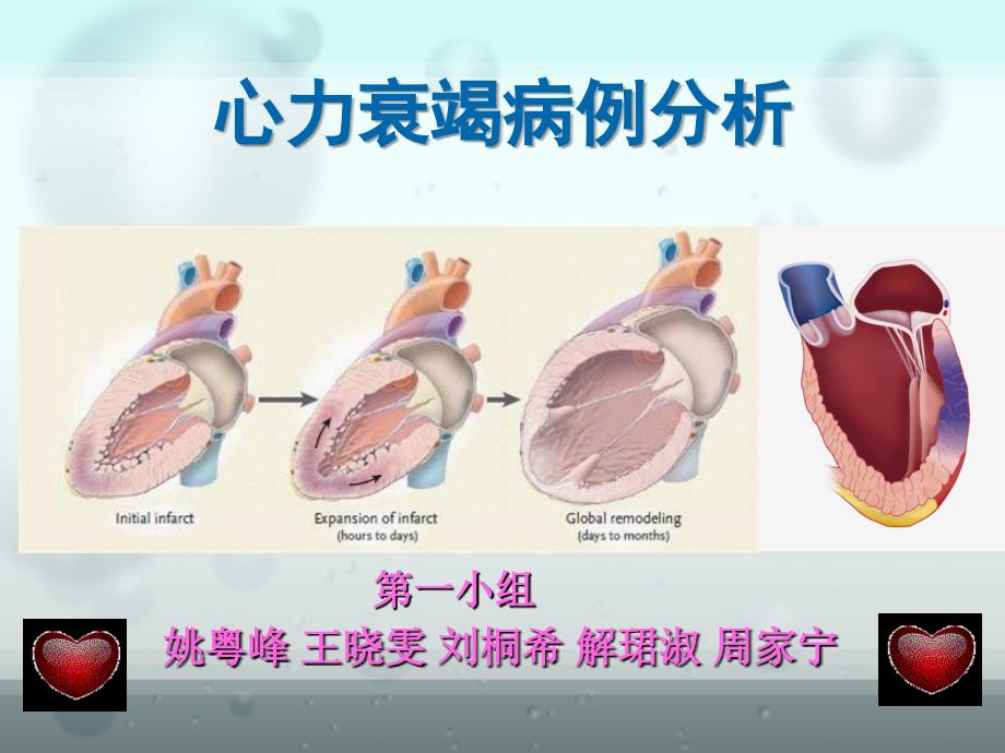 心力衰竭病例分析PPT通用课件_第1页