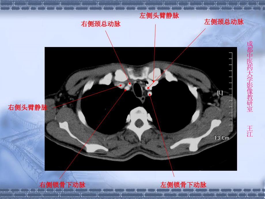 肺部CT-肺部纵隔窗_第1页