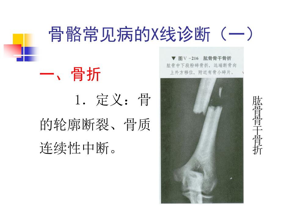 骨骼常见病的X线诊断_第1页