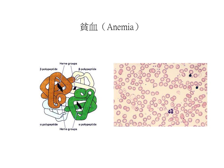 -贫血(Anemia)课件_第1页