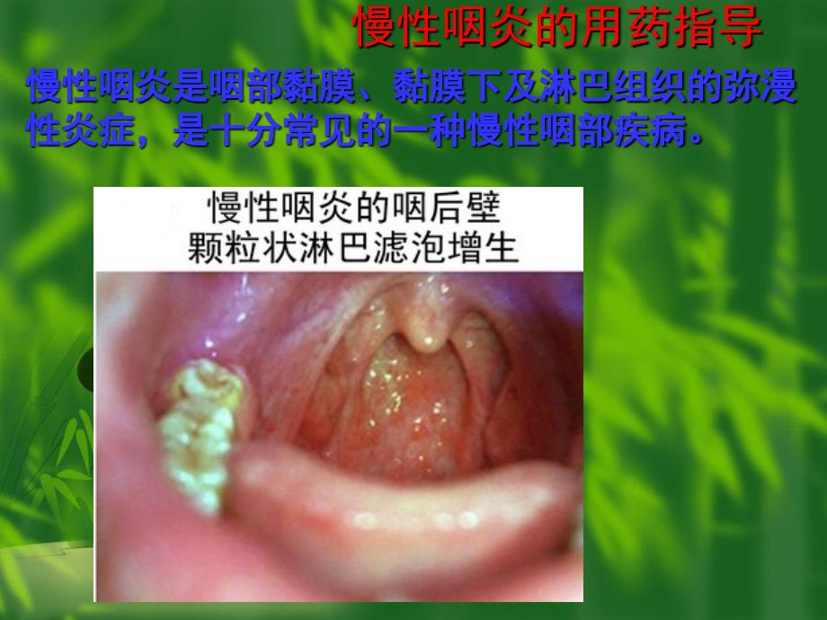 慢性咽炎的用药指导_第1页