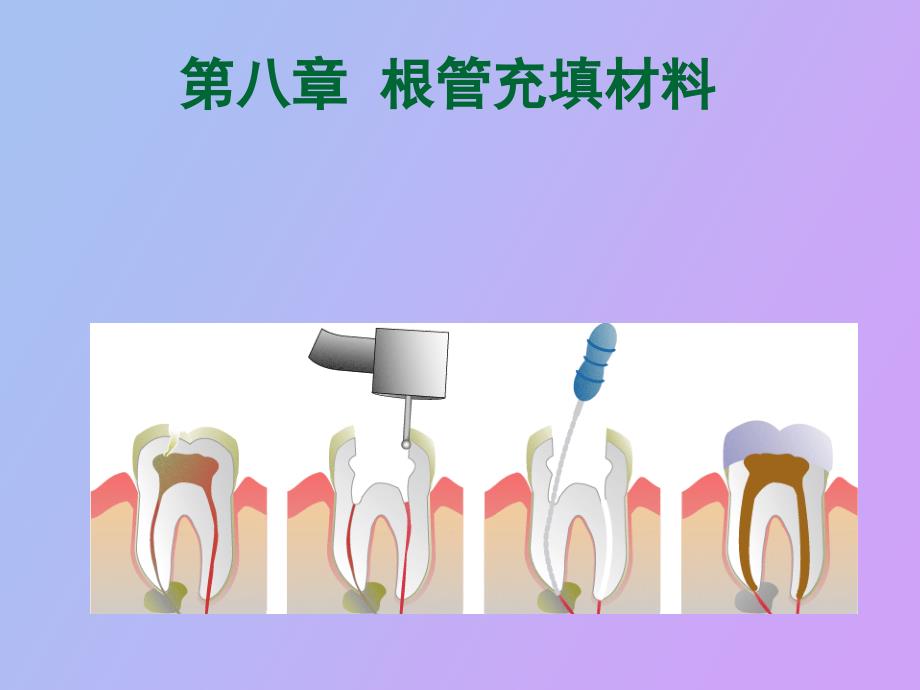 根管充填材料_第1页