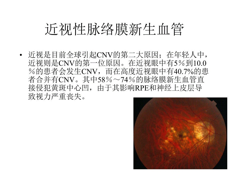 高度近视黄斑新生血管改课件_第1页