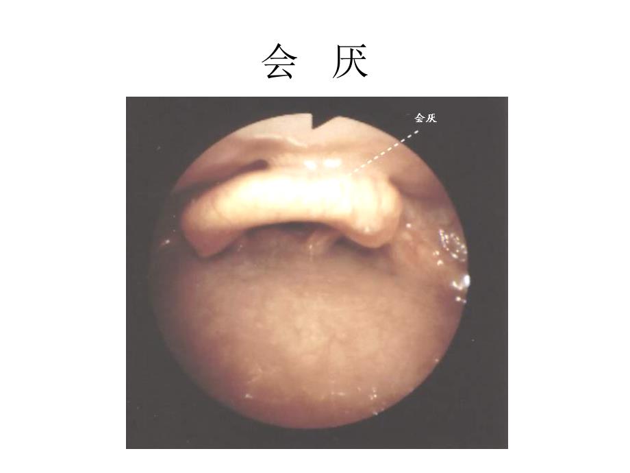 纤维支气管镜解剖课件_第1页