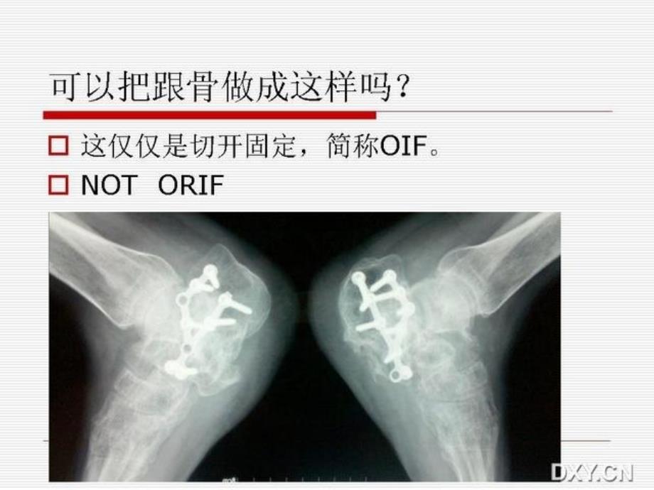 跟骨骨折复位课件_第1页