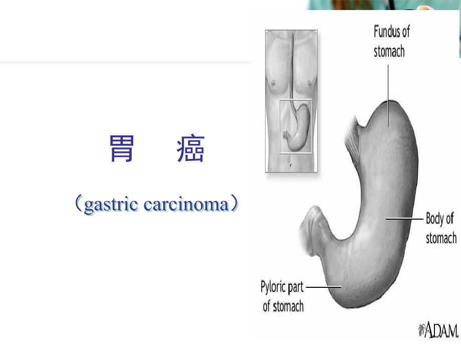 胃癌教学课件幻灯片课件_第1页