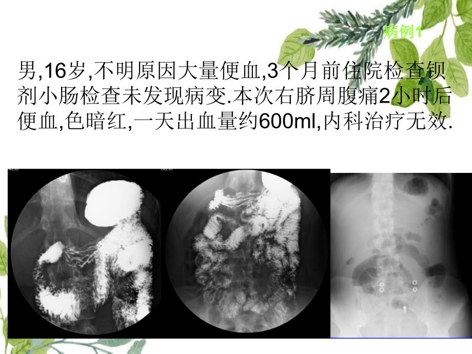 麦克尔憩室的影像学诊断_第1页