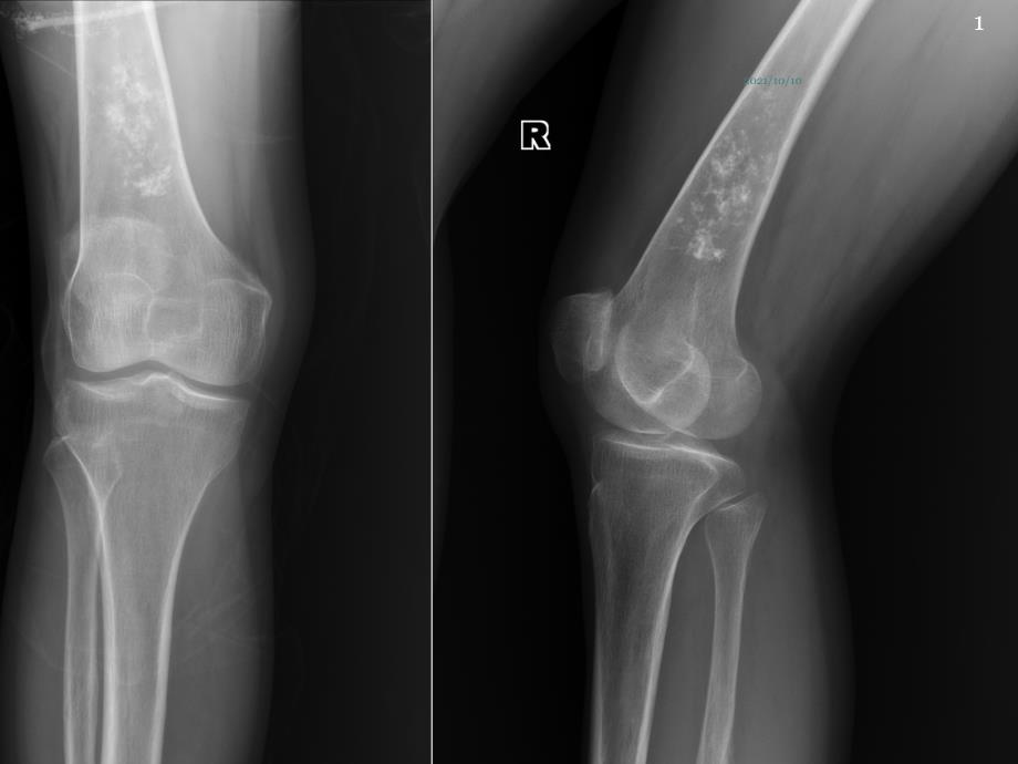 骨梗死影像诊断-读片_第1页