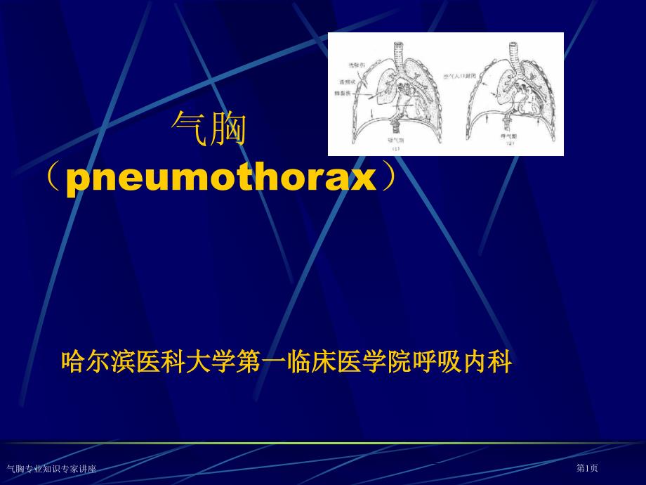 气胸专业知识专家讲座_第1页