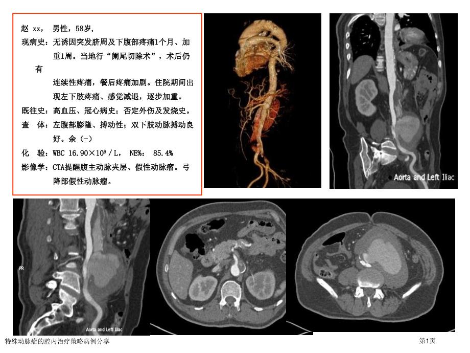 特殊動脈瘤的腔內(nèi)治療策略病例分享_第1頁