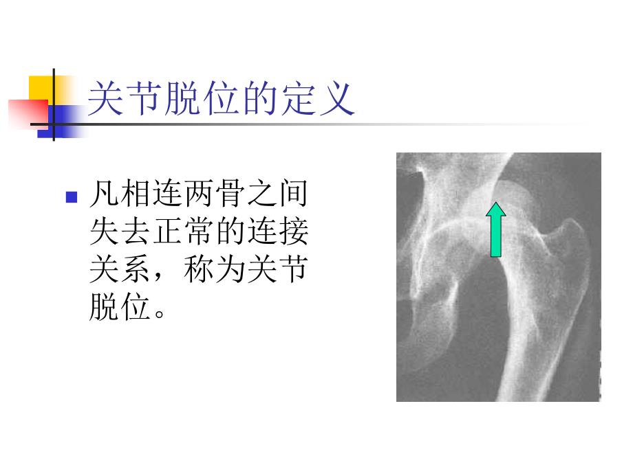 关节脱位的急救课件_第1页