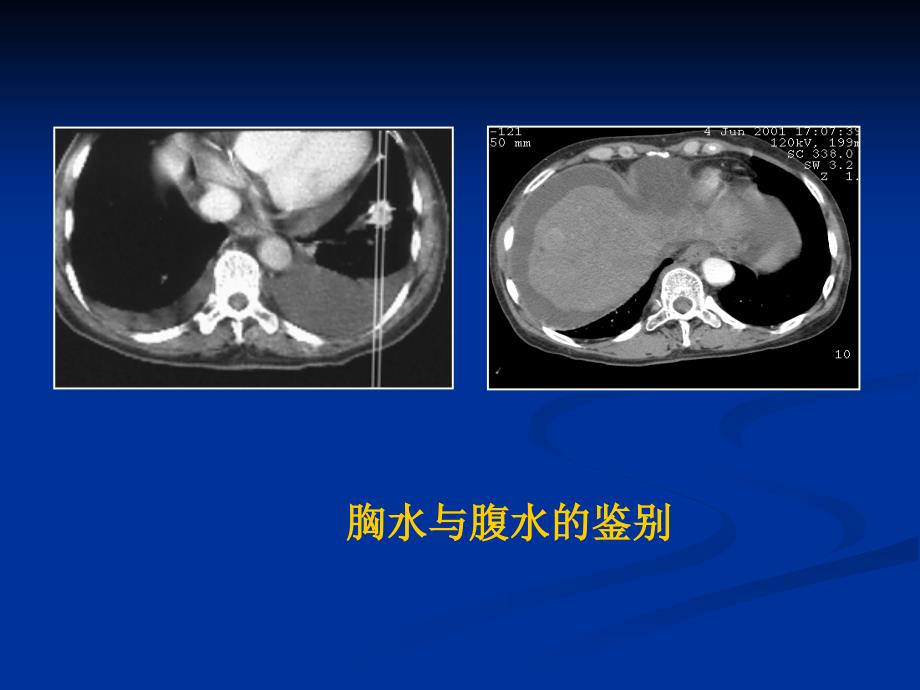 肺血液循环障碍性疾病_第1页