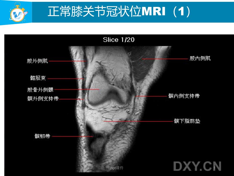 膝关节MRI冠状位课件_第1页