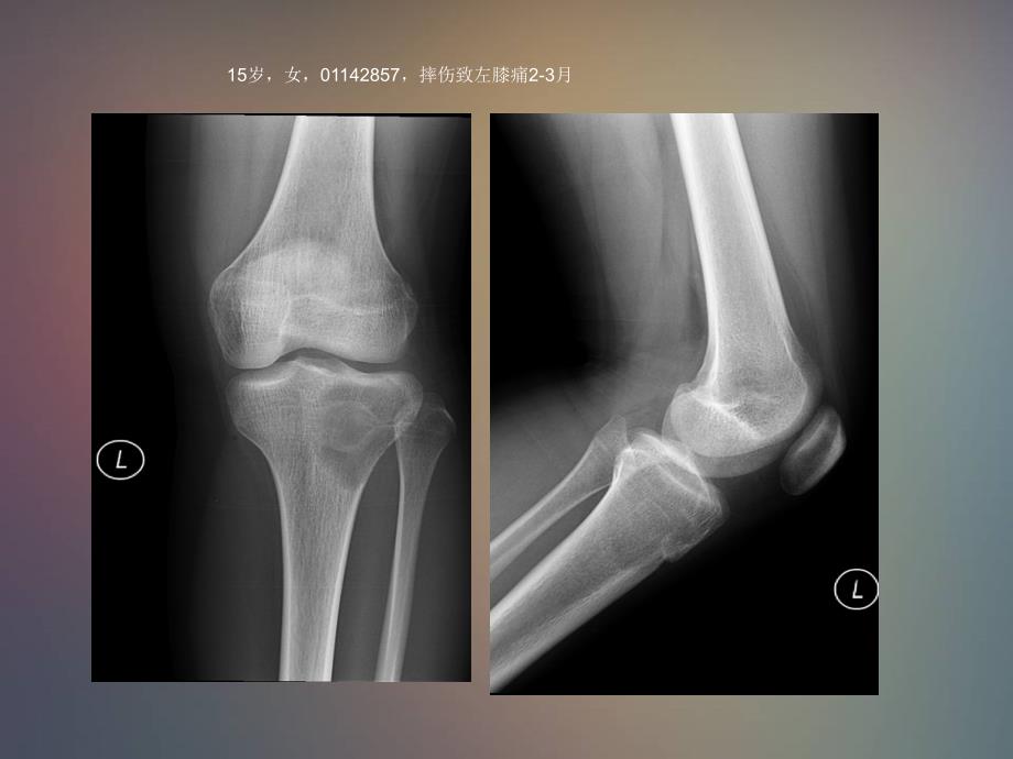 软骨母细胞瘤的影像诊疗分析_第1页