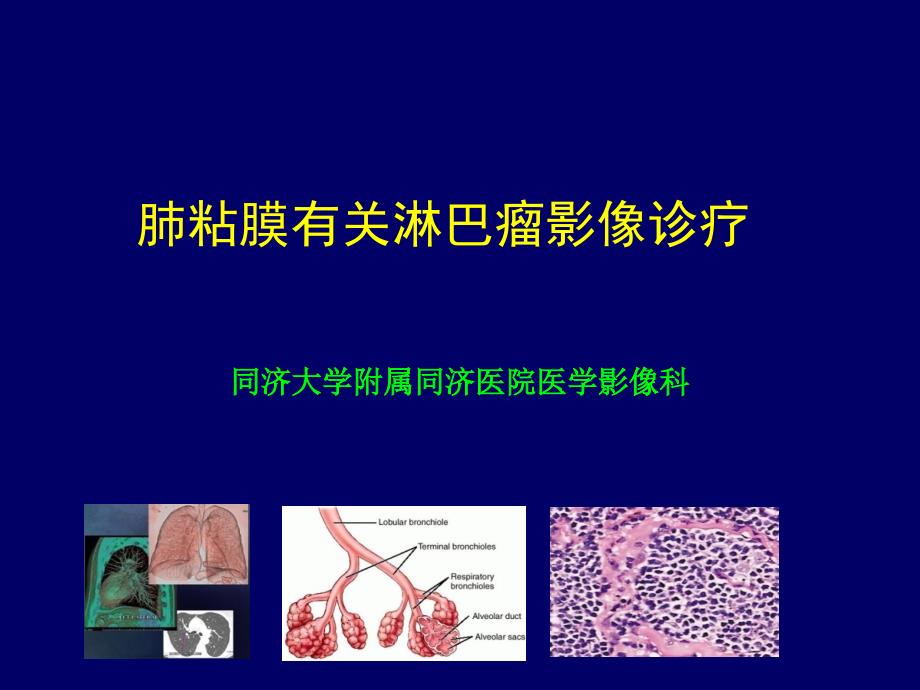 肺粘膜相关淋巴瘤影像特征_第1页